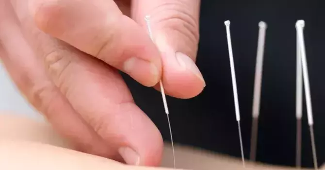 Acupuncture